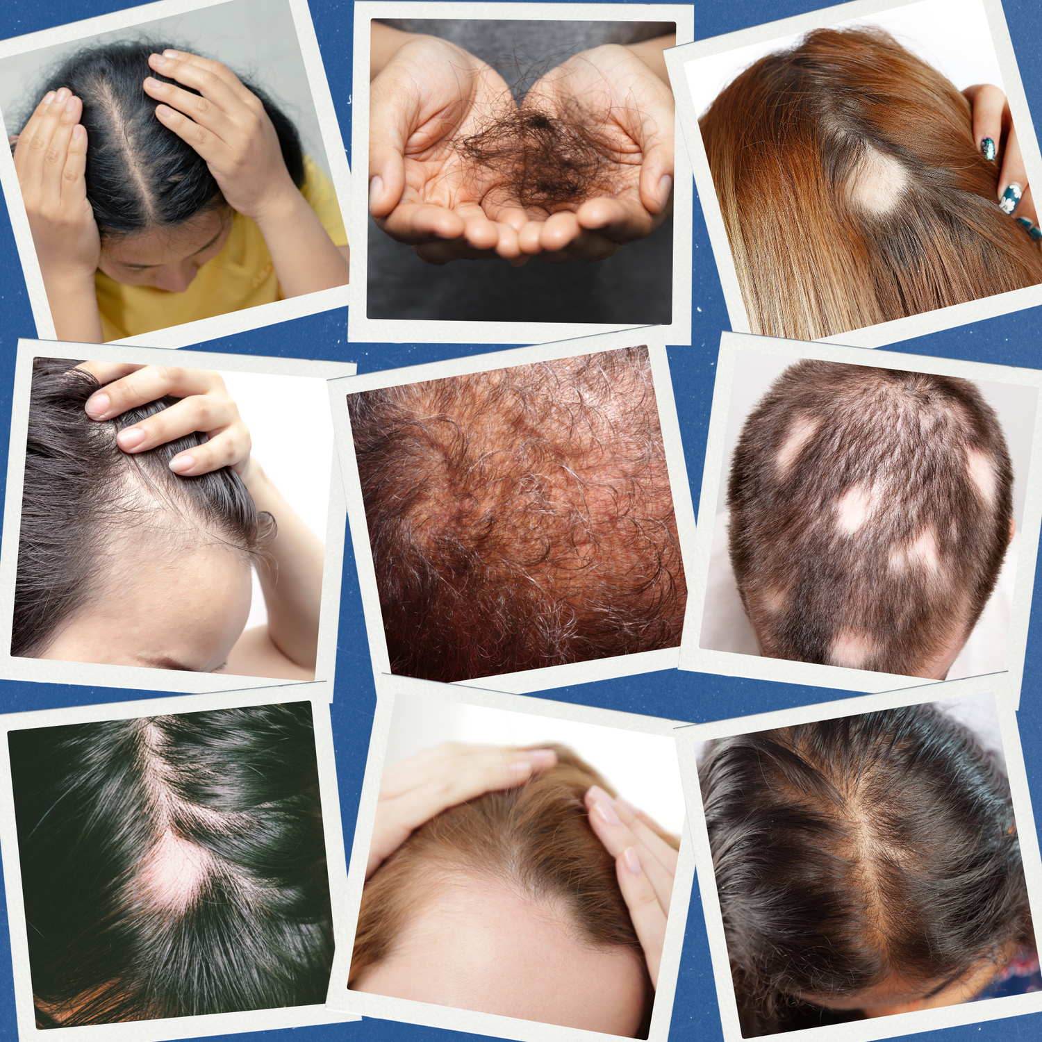 Collage van afbeeldingen die verschillende vormen van haaruitval en hoofdhuidproblemen.