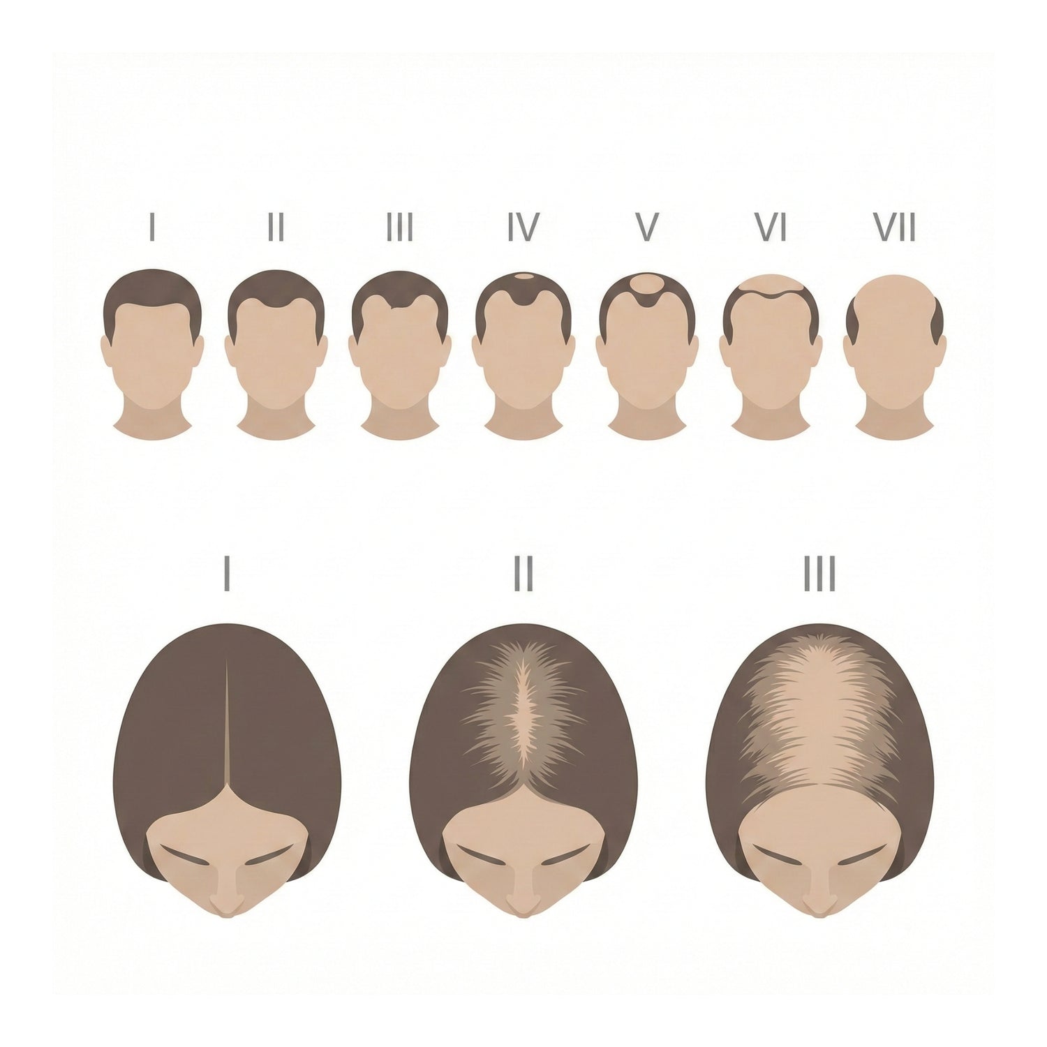 Norwood-Hamilton en Ludwig classificatie bij alopecia androgenetica.