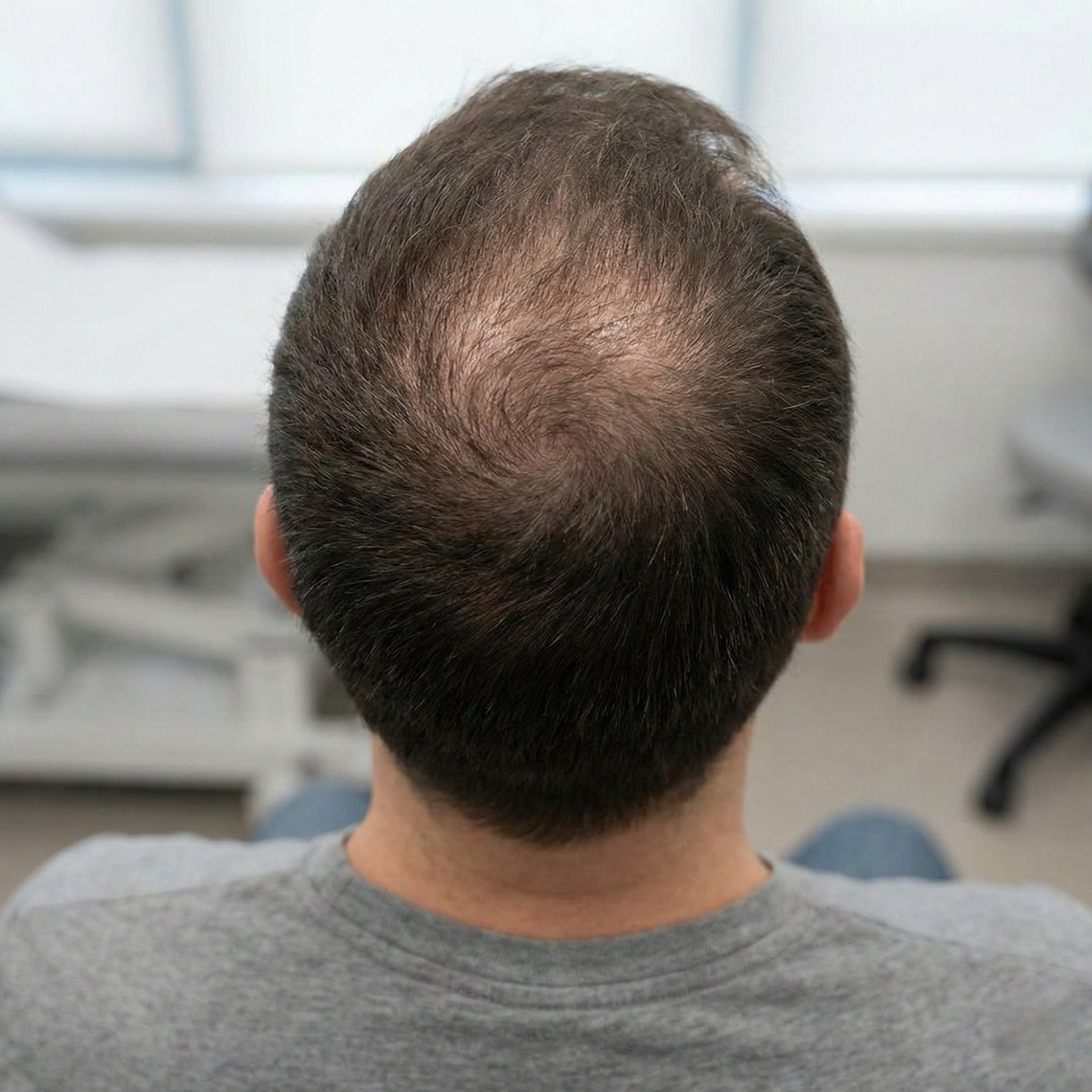 Afbeelding van alopecia androgenetica met haarverdunning op de kruin bij een man