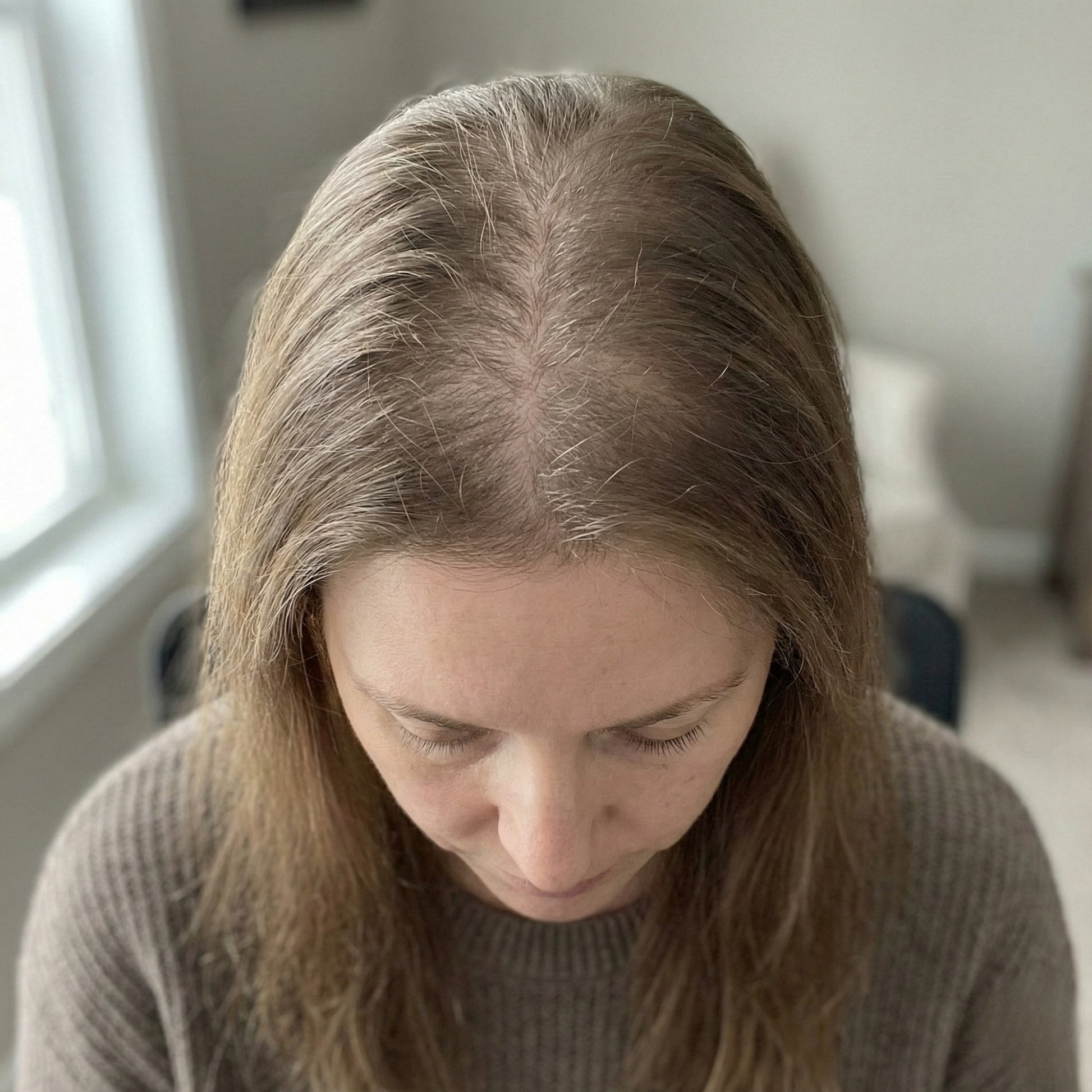 Diffuus haarverlies bij vrouwen